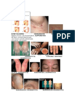 Acne Vulgaris Hidradenitis Dermatitis: Stages of Acne. (A) Normal Follicle SUPPURATIVA (C) Closed Comedo (Whitehead)