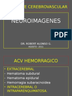 Neuroimagenes en Accidente Cerebrovascular