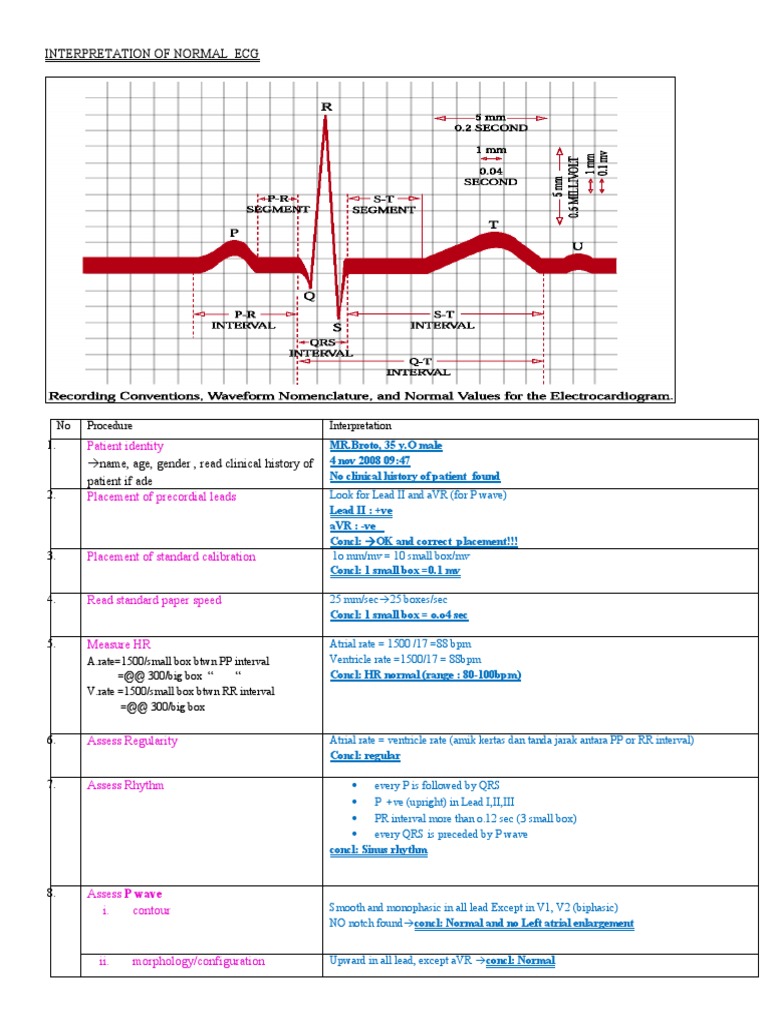 Interpretation of Normal Ecg | Electrocardiography | Cardiology