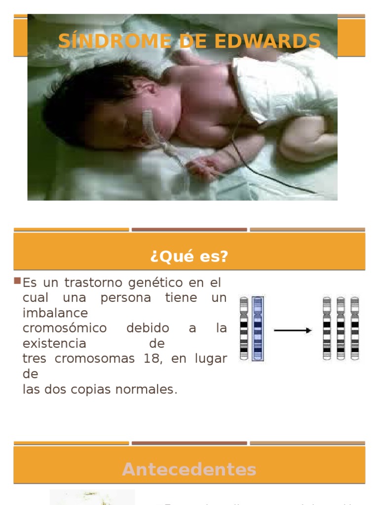 Sindrome de Edwards | PDF | Cariotipo | Especialidades Medicas