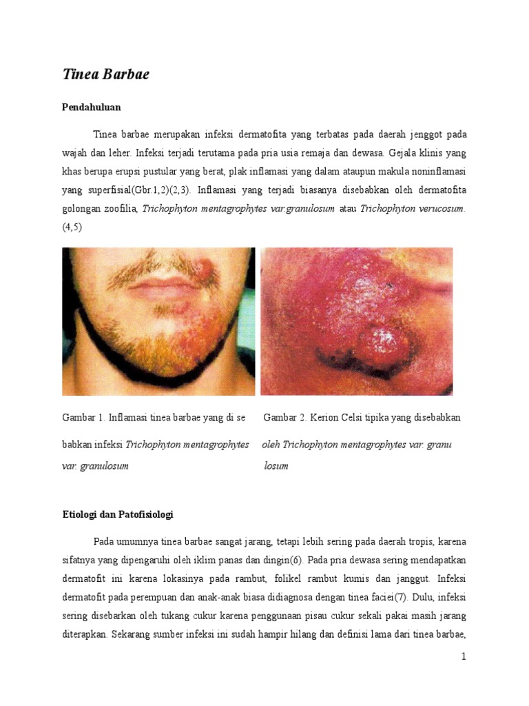 Tinea Barbae | PDF