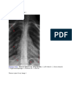 Thoracic Spine X-Ray