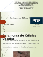 Carcinoma de Celulas Basales