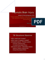 Epidural Hematoma