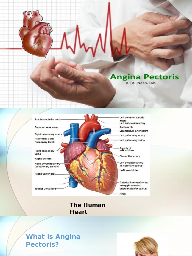 Angina Pectoris | PDF | Angina Pectoris | Percutaneous Coronary ...