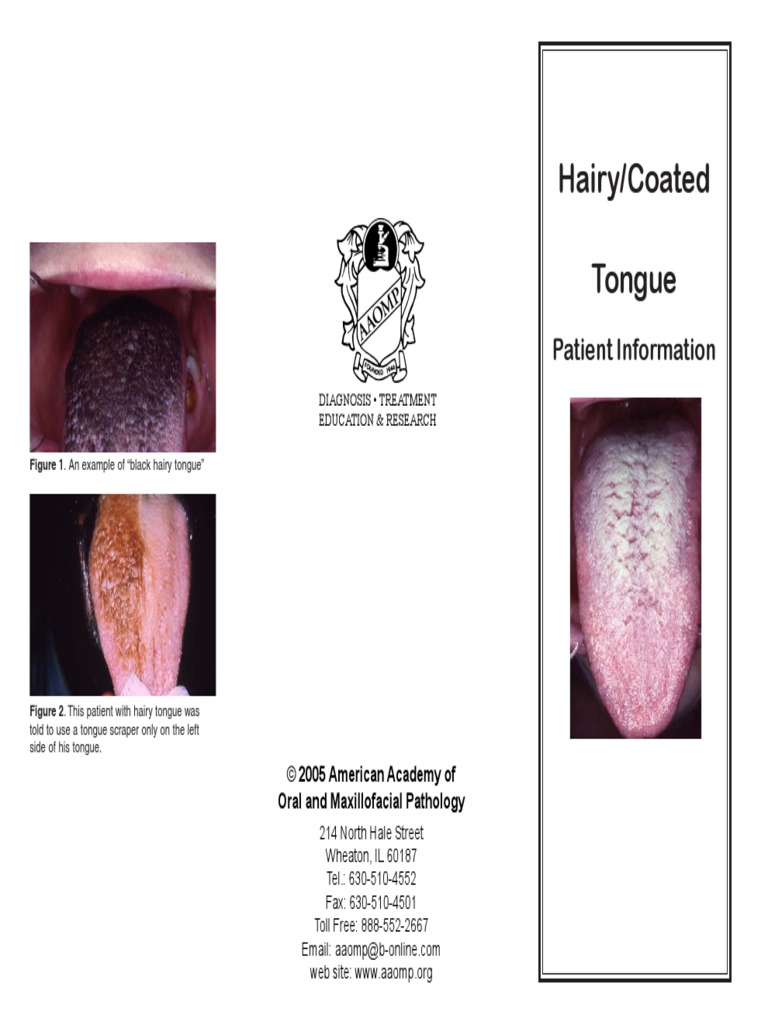 Hairy Tounge pdf Tongue Medicine