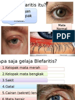 Blefaritis
