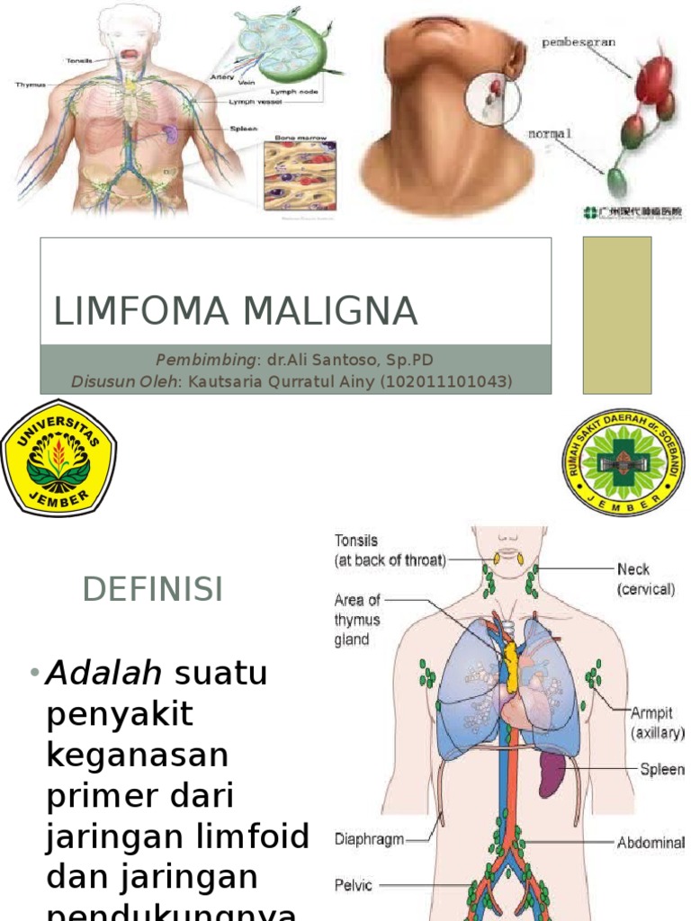 Limfoma Maligna Pdf