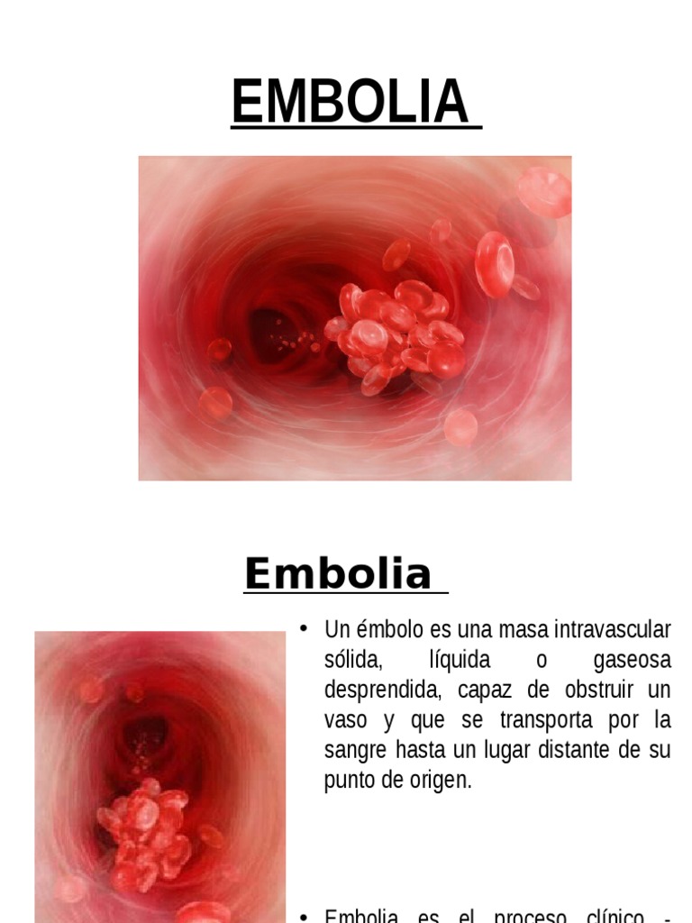 Embolia | PDF
