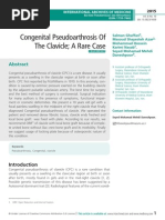 Congenital Pseudoarthrosis Of The Clavicle; A Rare Case