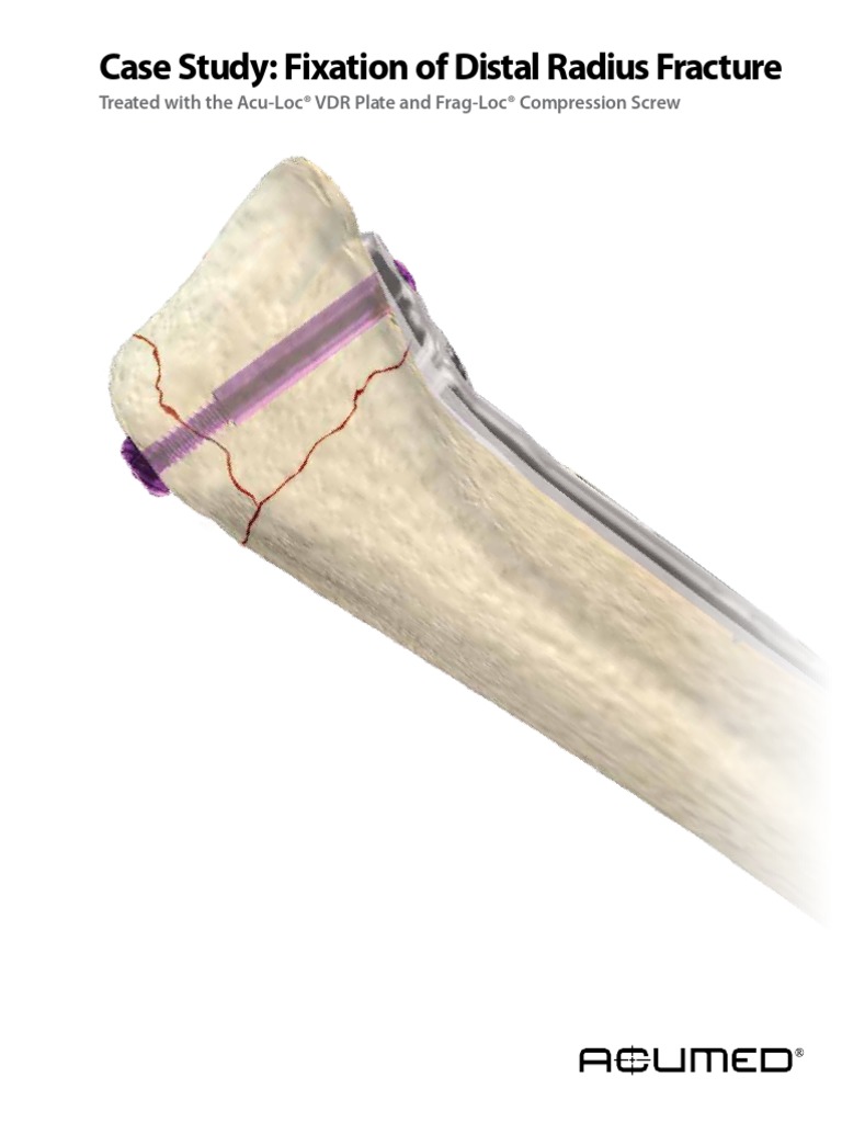 Case study on tibia fracture image