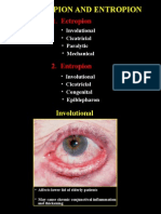 06ectropion & Entropion