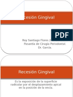 Recesión Gingival