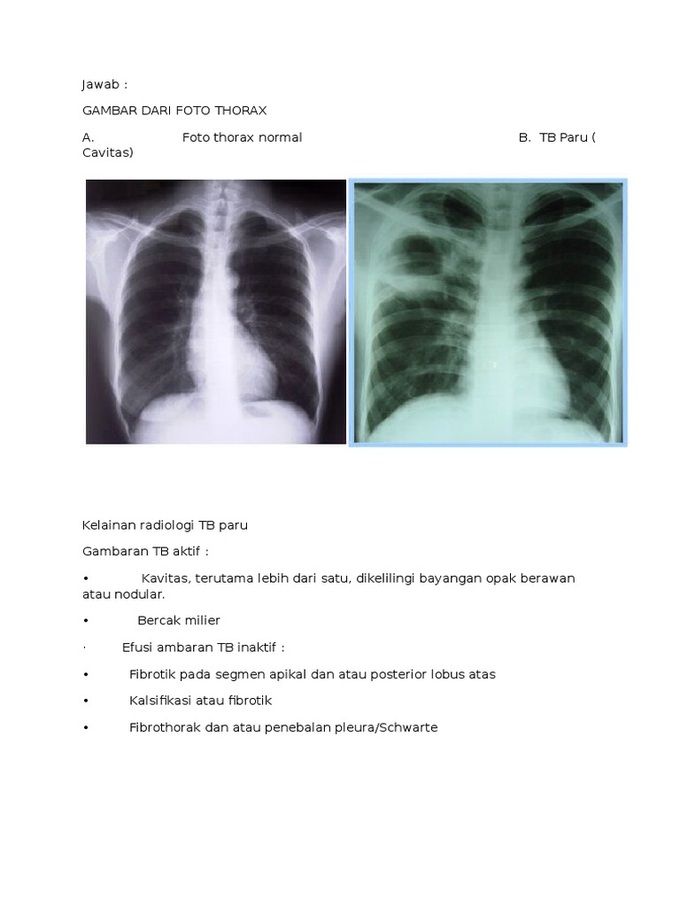 Gambaran Radiologi TB Paru dan Efusi | PDF | Sains & Matematika