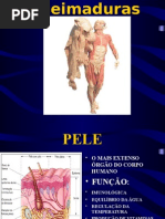 Queimaduras 