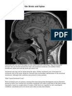 Arachnoid Cysts of The Brain and Spine