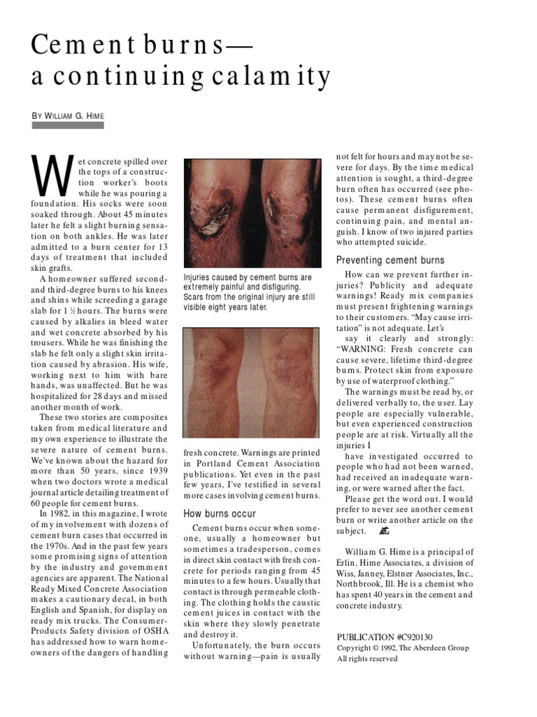 Cement Burns A Continuing Calamity PDF Burn Concrete