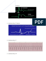 Gambaran EKG