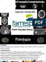 Patologia Do CRANIO Na Tomografia Computadorizada