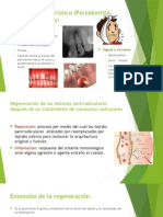 Absceso Apical Crónico (Periodontitis Apical Supurativa)