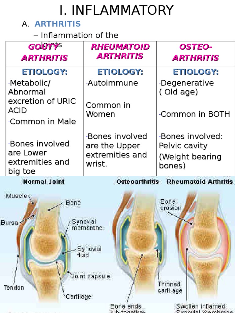 Arthritis Gouty Arthritis Rheumatoid Arthritis OsteoArthritis PDF