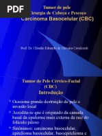AULA 1 - Carcinoma Basocelular