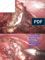 Total Laparoscopic Hysterectomy Part5