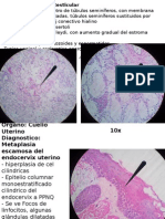 ATROFIA TESTICULAR Y METAPLASIA ESCAMOSA ENDOCERVICAL