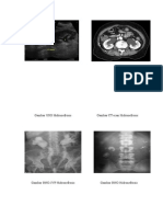 Gambar USG Hidronefrosis                               Gambar CT.docx