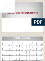 Ecg