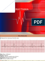 Bradiaritmia