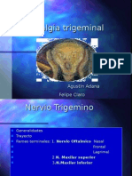 Neuralgia Del Trigemino