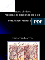 Neoplasias Benignas