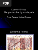 Neoplasias benignas