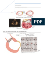 Figure 33-1 Cardiac Remodeling Secondary To Volume Overload