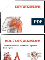 Infarto Agudo Del Miocardio