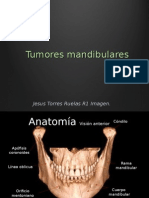 Tumores Mandibulares