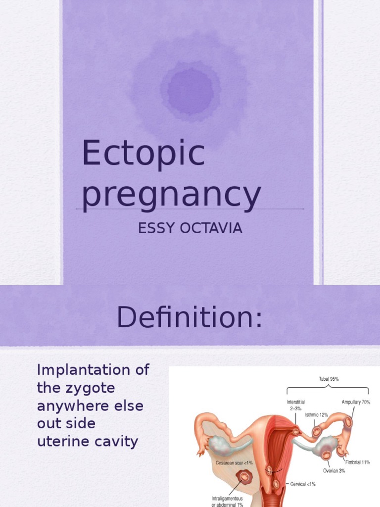 Ectopic Pregnancy Essy Octavia PDF Women's Health Pregnancy