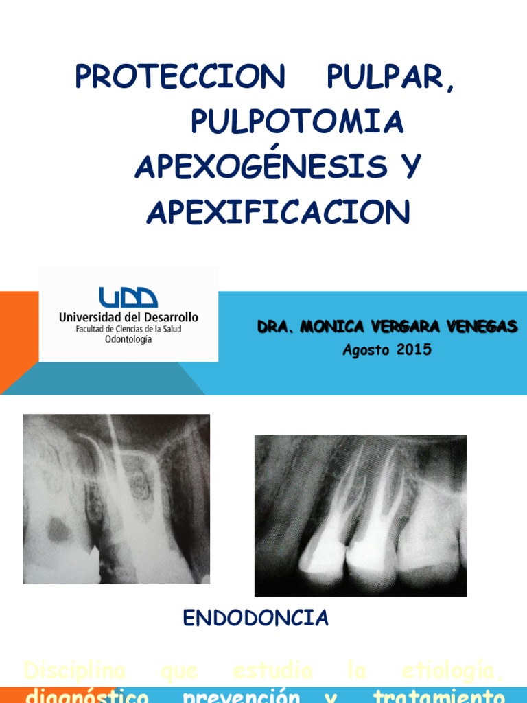 Proteccion Pulpar, Pulpotomia Apexogénesis Y Apexificacion