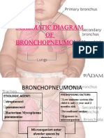 Schematic Diagram OF Bronchopneumonia