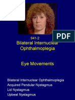 Bilateral Internuclear Ophthalmoplegia