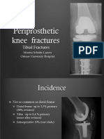 3.3 Tibial Fractures