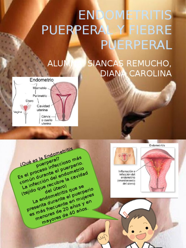 Endometritis Puerperal y Fiebre Puerperal Periodo posparto Parto