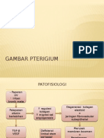 Gambar Pterigium