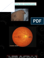 Retinopatía Del Prematuro