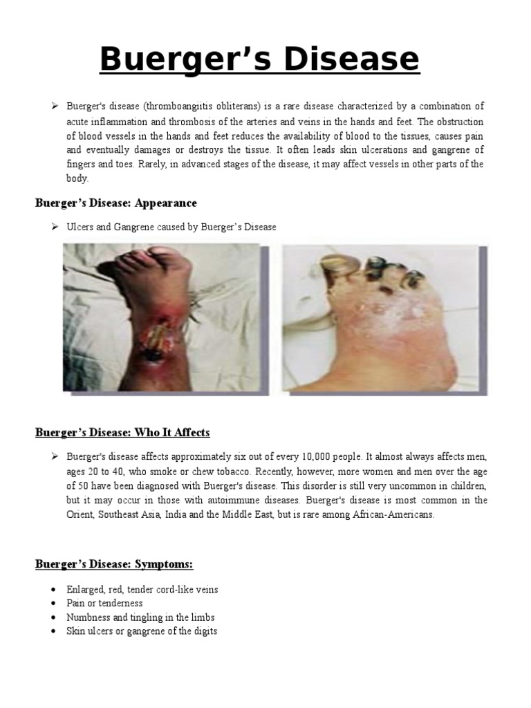 Buerger's Disease Cardiovascular System Angiology