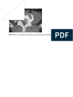 Figure 29. L4-L5 CT Diskogram Demonstrating A Large Left Posterolateral Radial Anular Tear Associated With