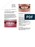 Diastema Itu Adalah Suatu Ruang Yang Terdapat Diantara Dua Buah Gigi Yang Berdekatan Yang Terjadi Karena Ketidaksesuaian Antara Lengkung Gigi Dengan Lengkung Rahang