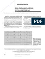 Hipokalemia y Ekg