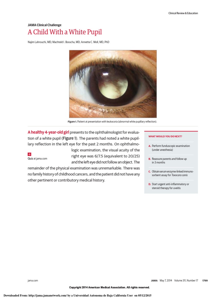 JAMA A Child With a White Pupil (Retinoblastoma) Neoplasms